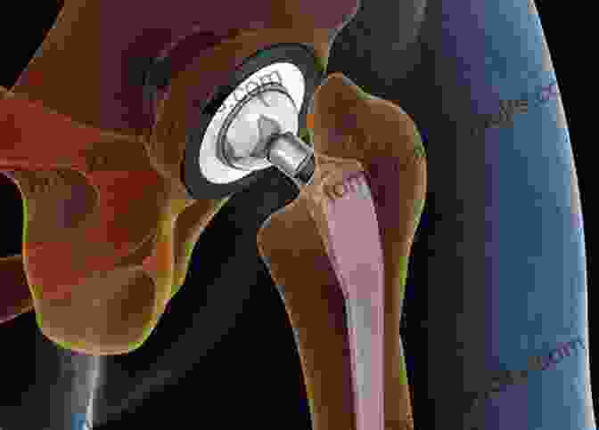 Surgeon Performing A Hip Replacement Procedure, Highlighting The Replaced Artificial Joint. Hip And Knee Pain DisFree Downloads: An Evidence Informed And Clinical Based Approach Integrating Manual Therapy And Exercise